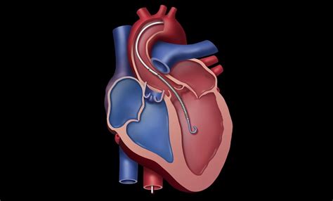 bills a screw pump heart|Principles of Impella Cardiac Support .